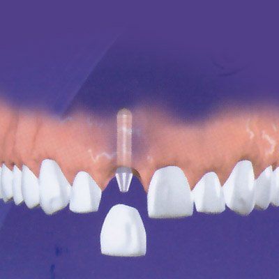 Tratamientos dentales en Valdepeñas. Implantología