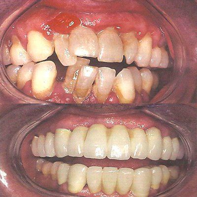 Tratamientos dentales en Valdepeñas. Periodoncia